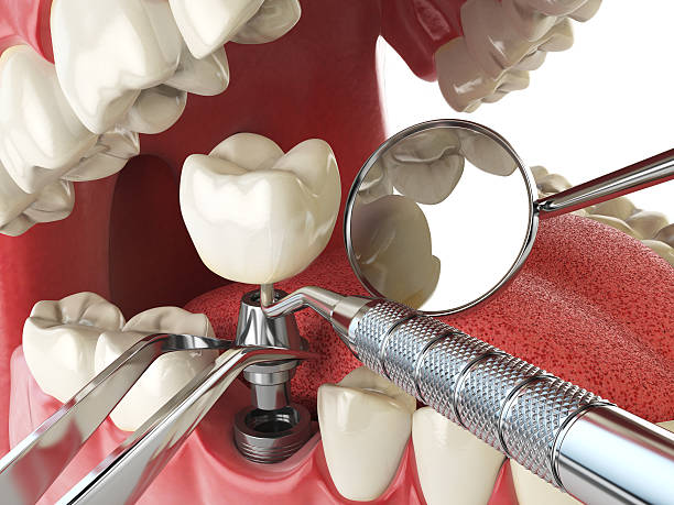 Best Emergency Dentist for Knocked-Out Tooth in Nebo, NC